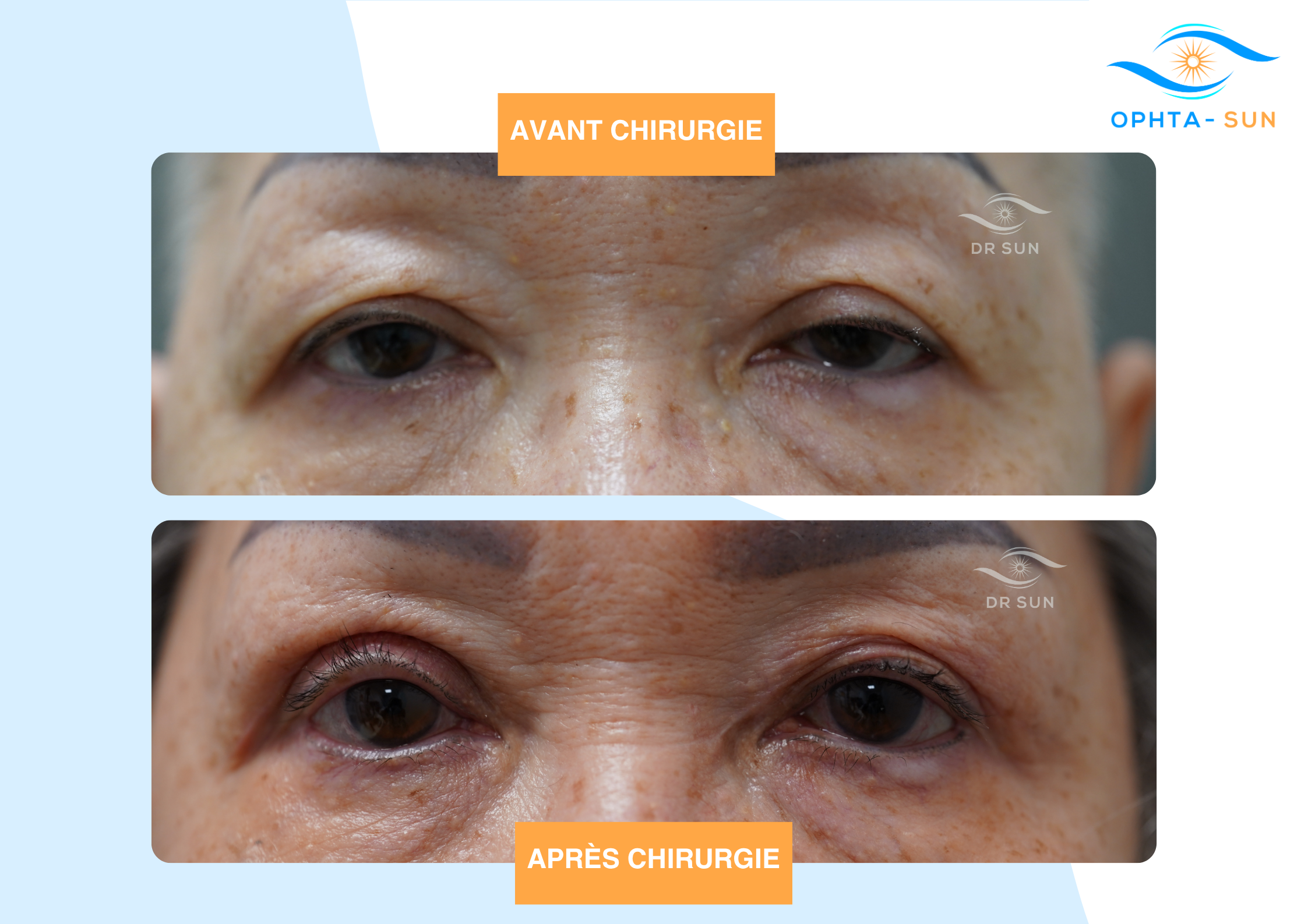 Ptosis asiatique avant après